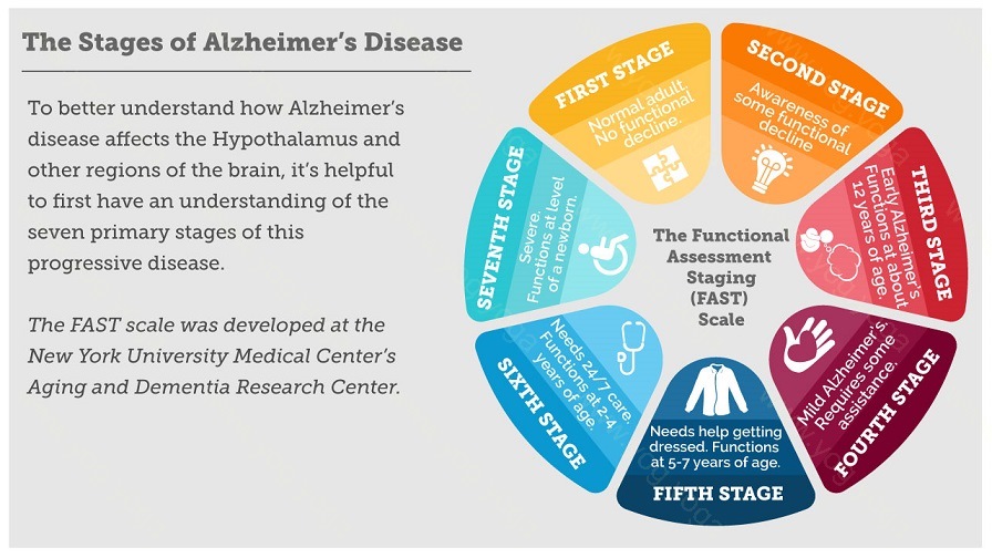 Alzheimer Disease Cure and Treatment in Basti  Uttar Pradesh