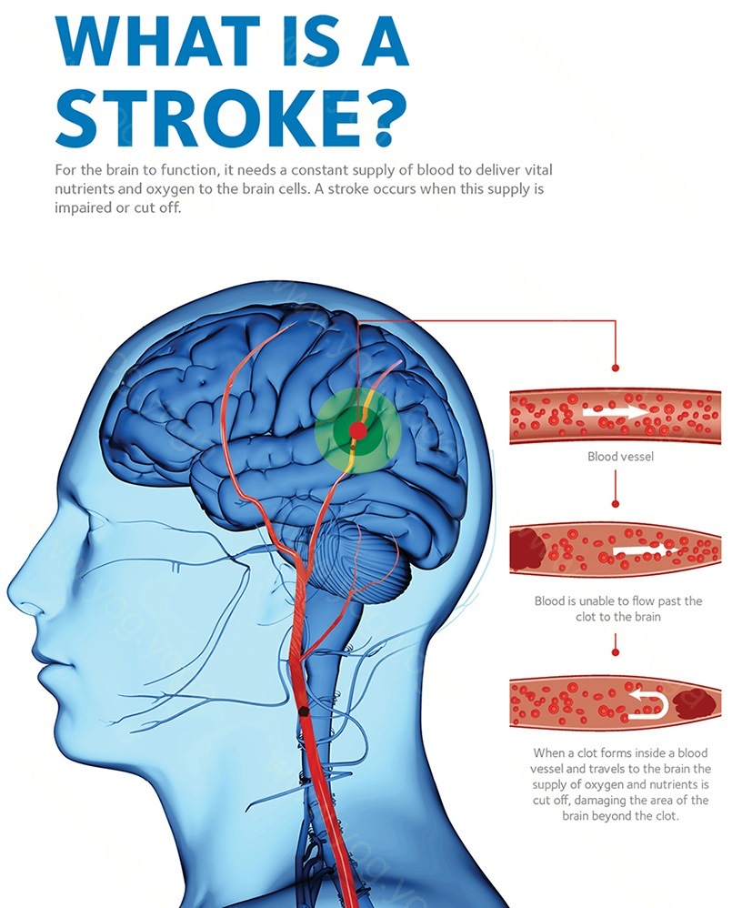 Brain Stroke Cure and Treatment in Jalandhar Punjab