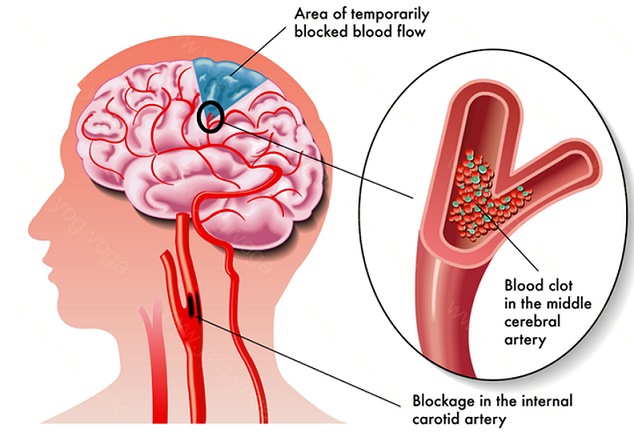 Brain Stroke Cure and Treatment in Ranchi Jharkhand