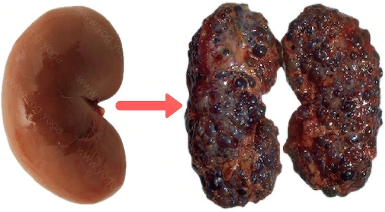 Kidney Disease Cure and Treatment in Rajnandgaon Chhattisgarh