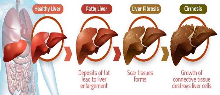 Liver Disease Cure and Treatment in Jamalpur Bihar