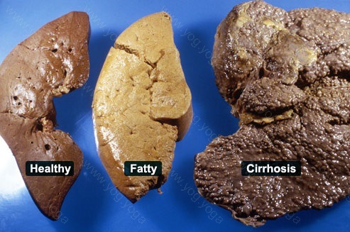 Liver Disease Cure and Treatment in Neemuch  Madhya Pradesh