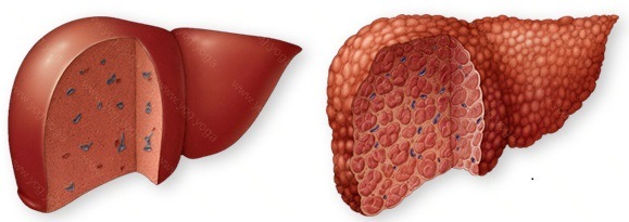 Liver Disease Cure and Treatment in Vidisha  Madhya Pradesh